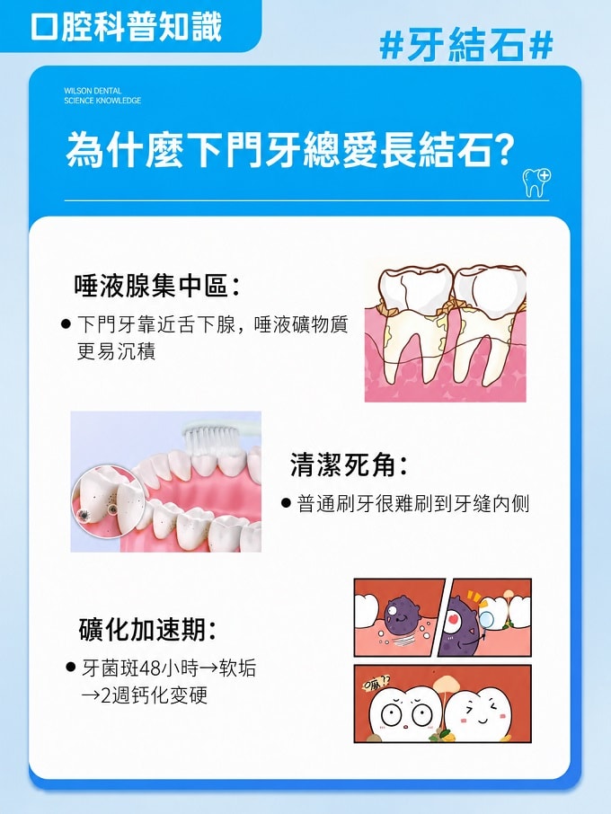 爲什麼下門牙總愛長結石