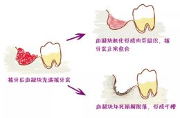 拔牙后注意！拔完牙为什么不能吐口水？
