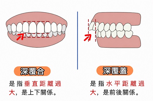 深覆合VS深覆蓋