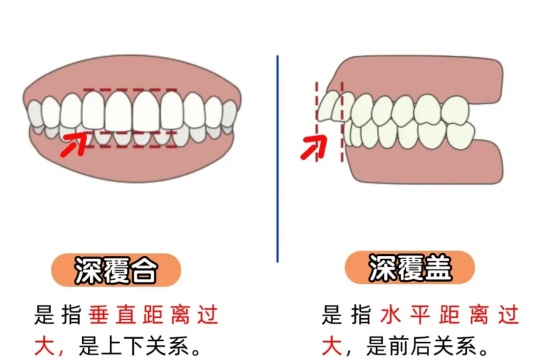 深覆合VS深覆盖