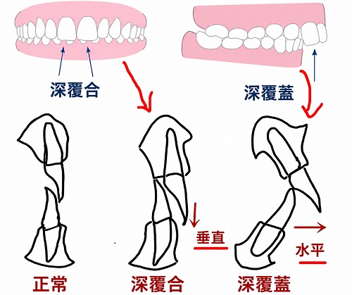 深覆合和深覆蓋