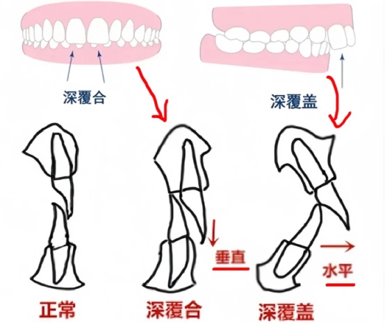 深覆合和深覆盖