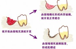 拔牙後注意！拔完牙為什麼不能吐口水？