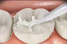 窩溝封閉不是牙齒的萬能”保險箱”