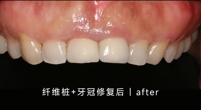 门牙断了修复