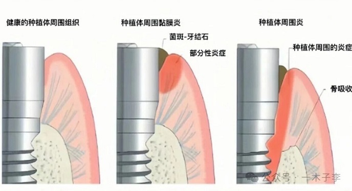 种植牙周围炎